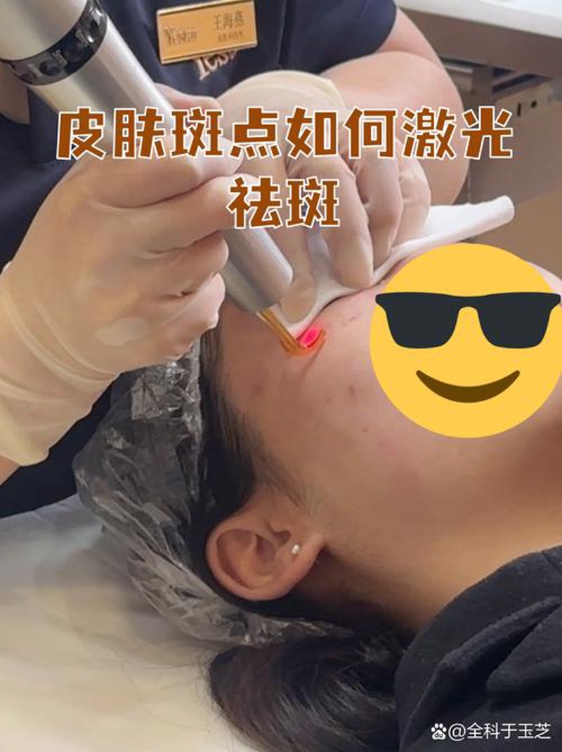 探寻激光祛斑技术，让肌肤焕然一新