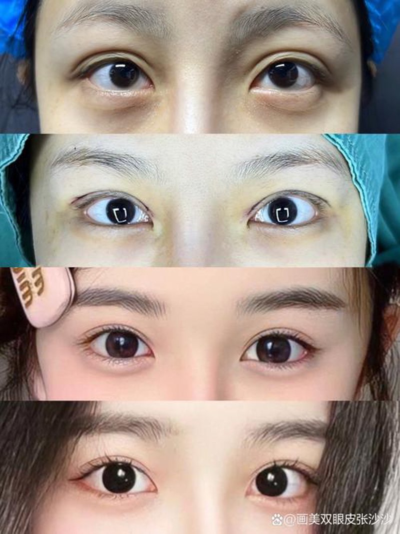 双眼皮手术：引领美眼新潮流