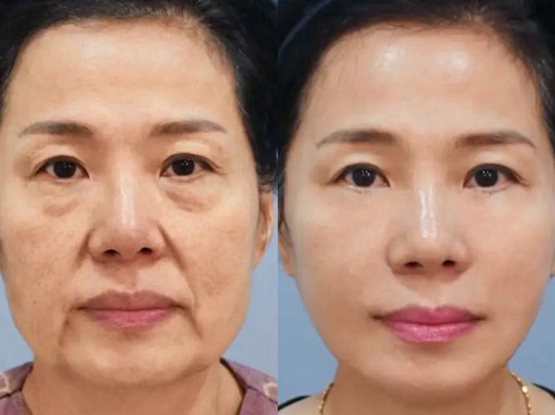 激光祛斑：科技与美学的完美结合