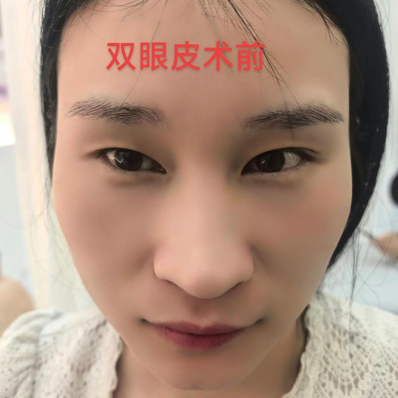 双眼皮手术：打造迷人眼眸的潮流趋势